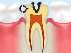 ［C2：　象牙質の虫歯］